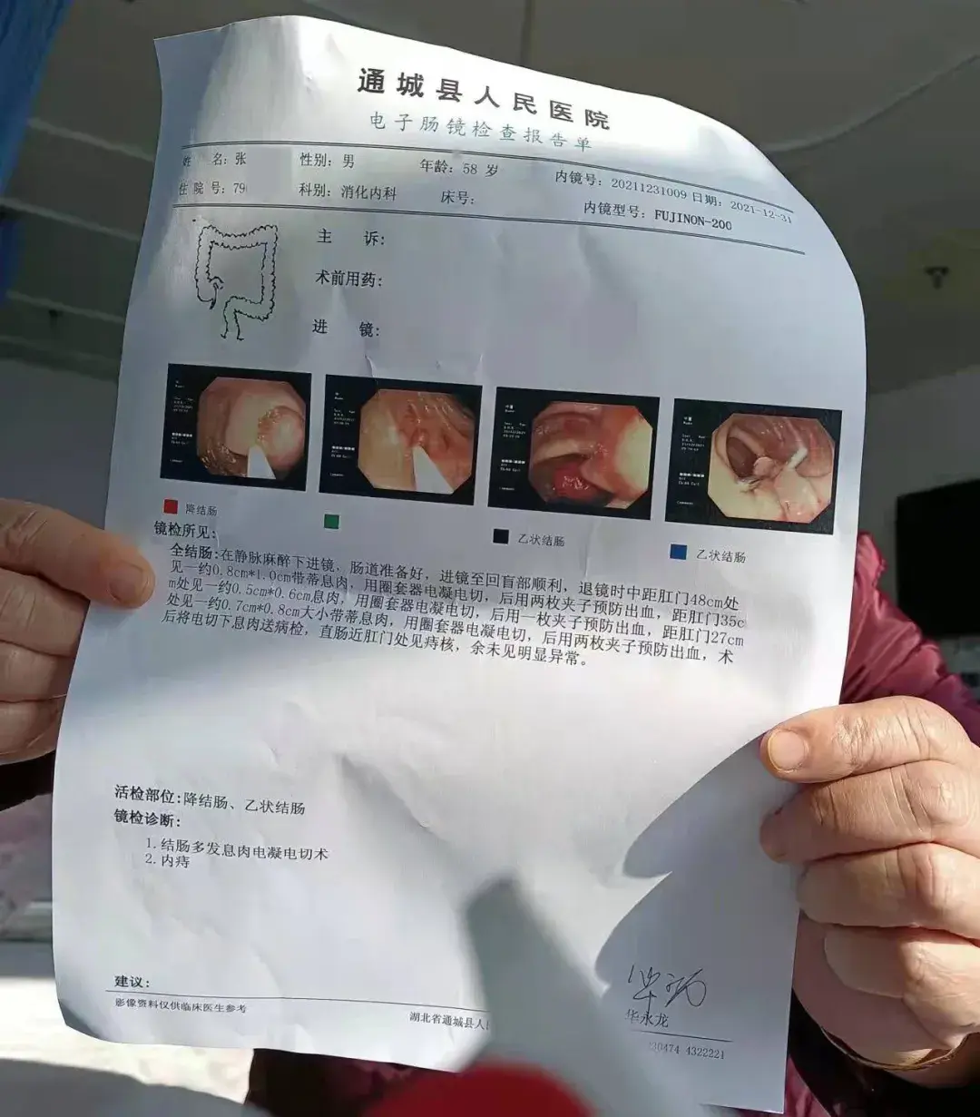 肠镜及病理报告单而对于通城县疾病预防控制中心而言,张大叔并不是