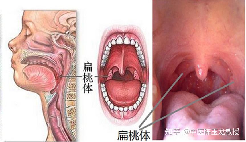 喉咙悬雍垂肿大怎么办图片