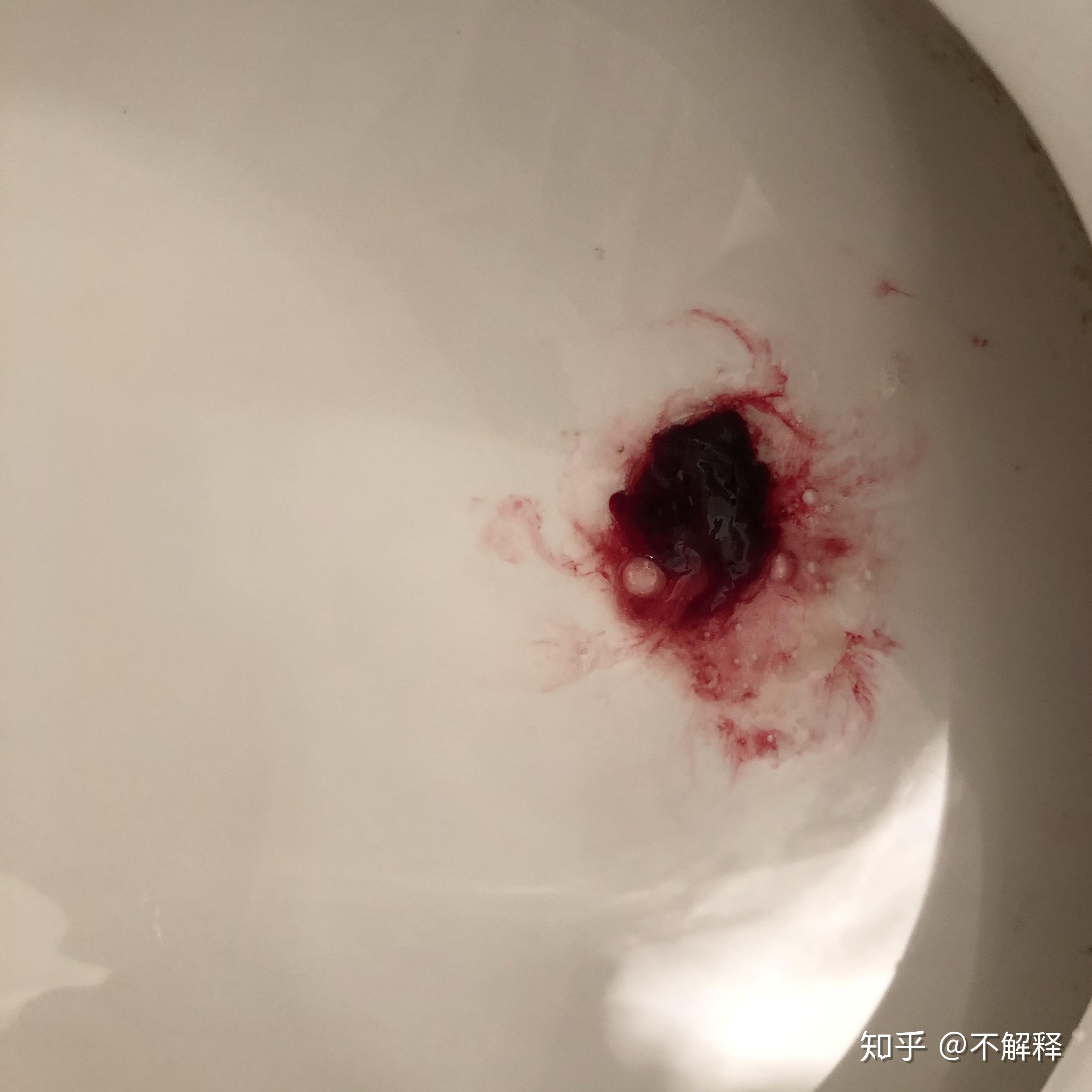 2020年出门就戴口罩不串门的我得了肺炎