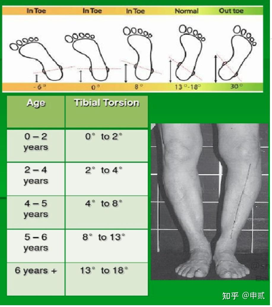 扁平足的康复治疗