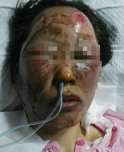 眉山女子出门被亲家泼汽油烧脸,用火砖拍头. - 知乎