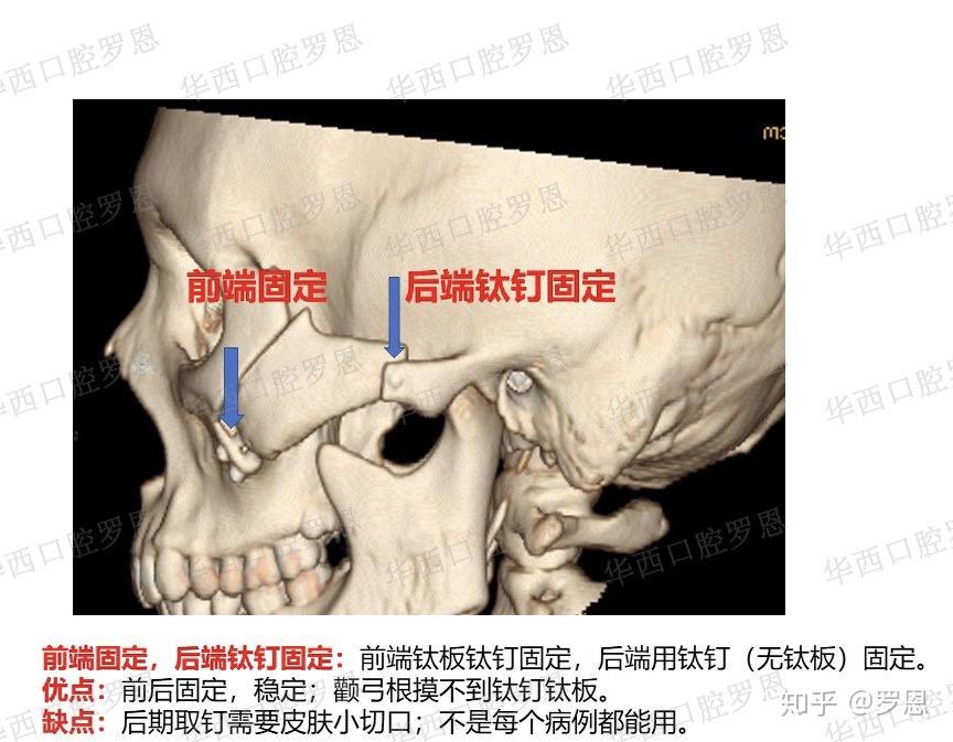 颧骨颧弓内推法图片