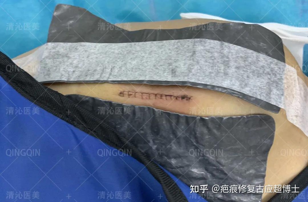 疤痕治疗是一个长周期的过程,手术结束并不代表疤痕治疗就这样结束了.