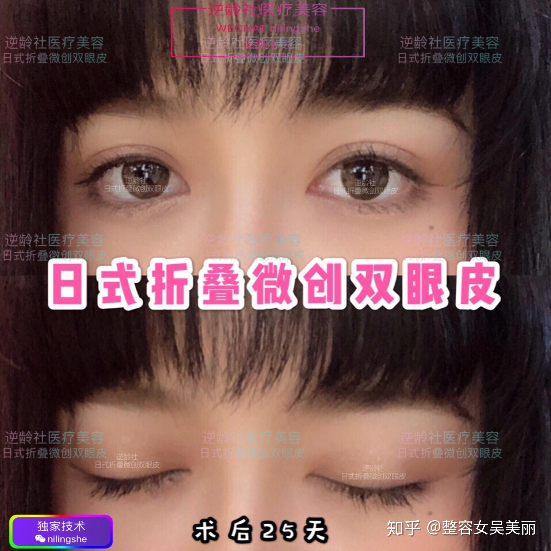 【医美大咖秀】上海日式无痕双眼皮专家-杜银燕医生_上海日式整形