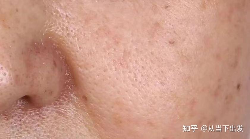【科普】你属于哪一种毛孔粗大类型? - 知乎