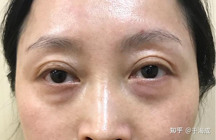 2术后一天且黑眼圈在祛眼袋手术中是比较难去的,轻微的黑