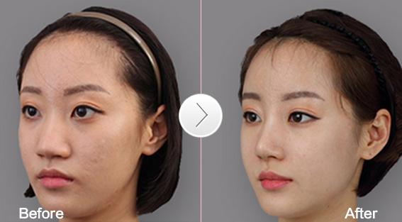 鼻翼缩小术娇俏美鼻缩出来