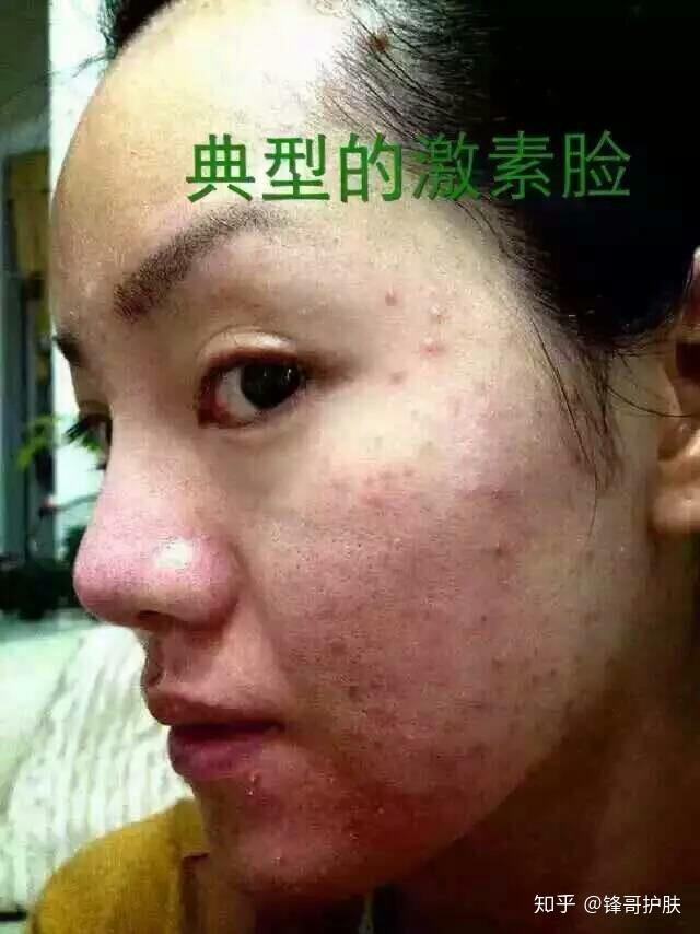 激素脸,也叫激素依赖性皮炎,是在长期外用含有糖皮质激素制剂的产品时