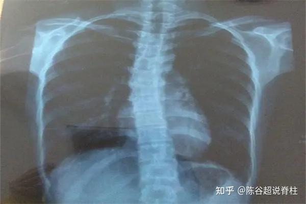 什么是胸椎脊柱侧弯?需要做手术吗? - 知乎