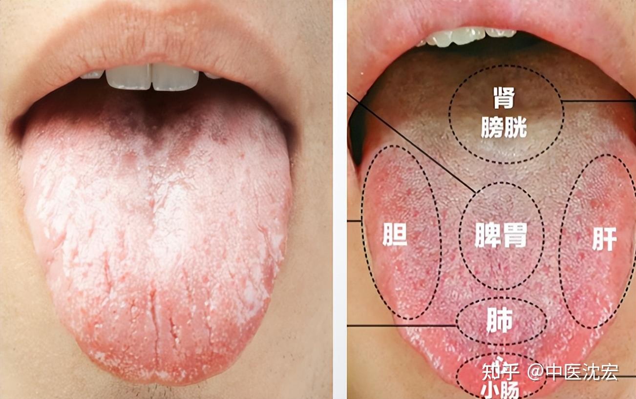你的舌头有异常吗？上面是不是有红色的小颗粒？（进来看看点刺舌长什么样） - 知乎
