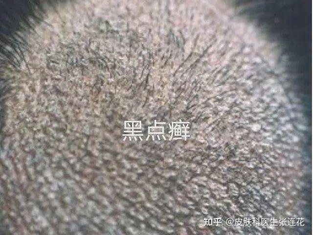 黑癣也可引起面部等处的光滑皮肤发生体癣和甲癣.