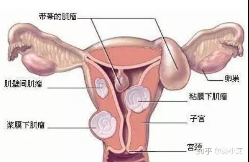 子宫肌瘤是怎么产生的 怎么治疗肌瘤最好 知乎