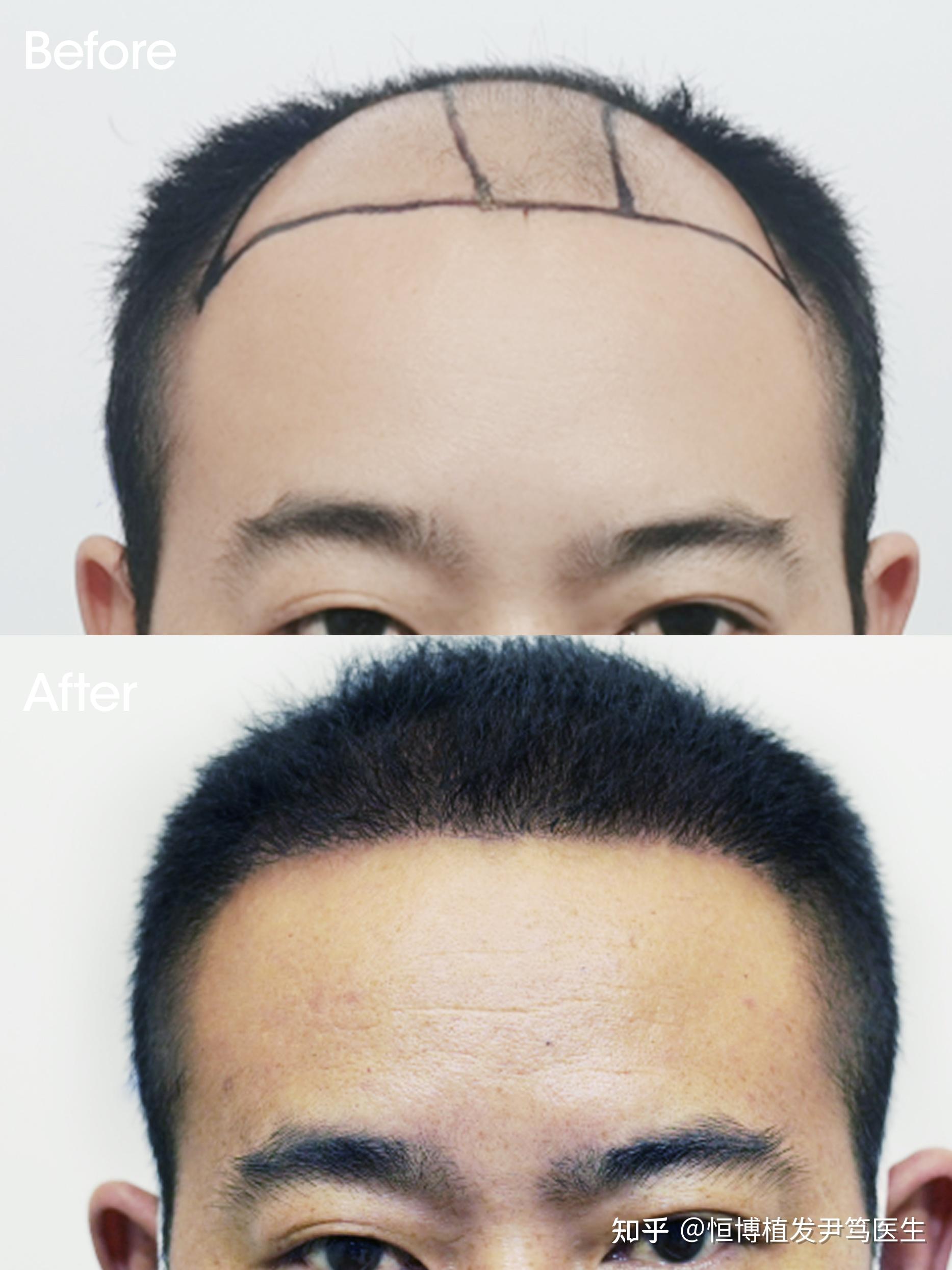正常人的发际线一般是怎么样的 - 知乎