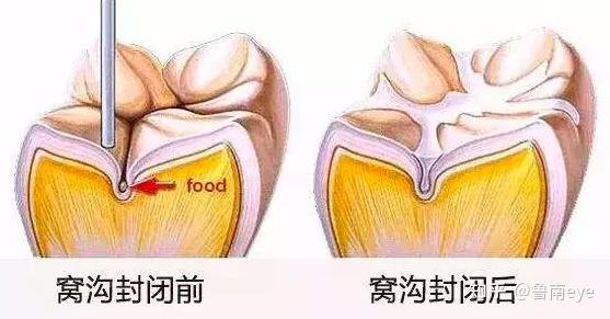 終生不換的六齡齒是什麼如何保護好六齡齒