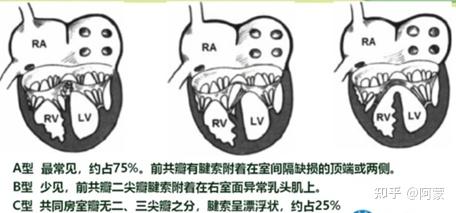 血流动力学部分型心内膜垫缺损 心房水平左向右分流