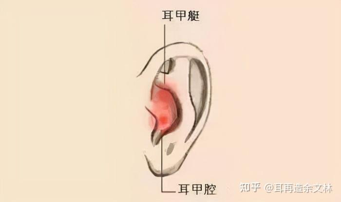 【科普】重塑后的耳朵为什么耳甲腔看起来不一样?