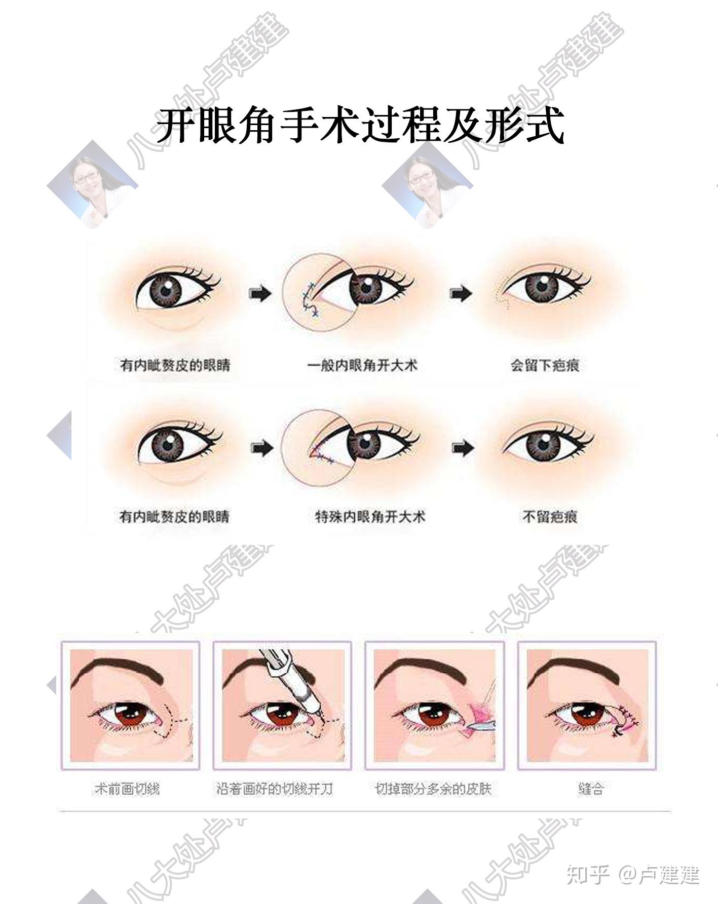 双眼皮开眼角内眦赘皮你了解吗