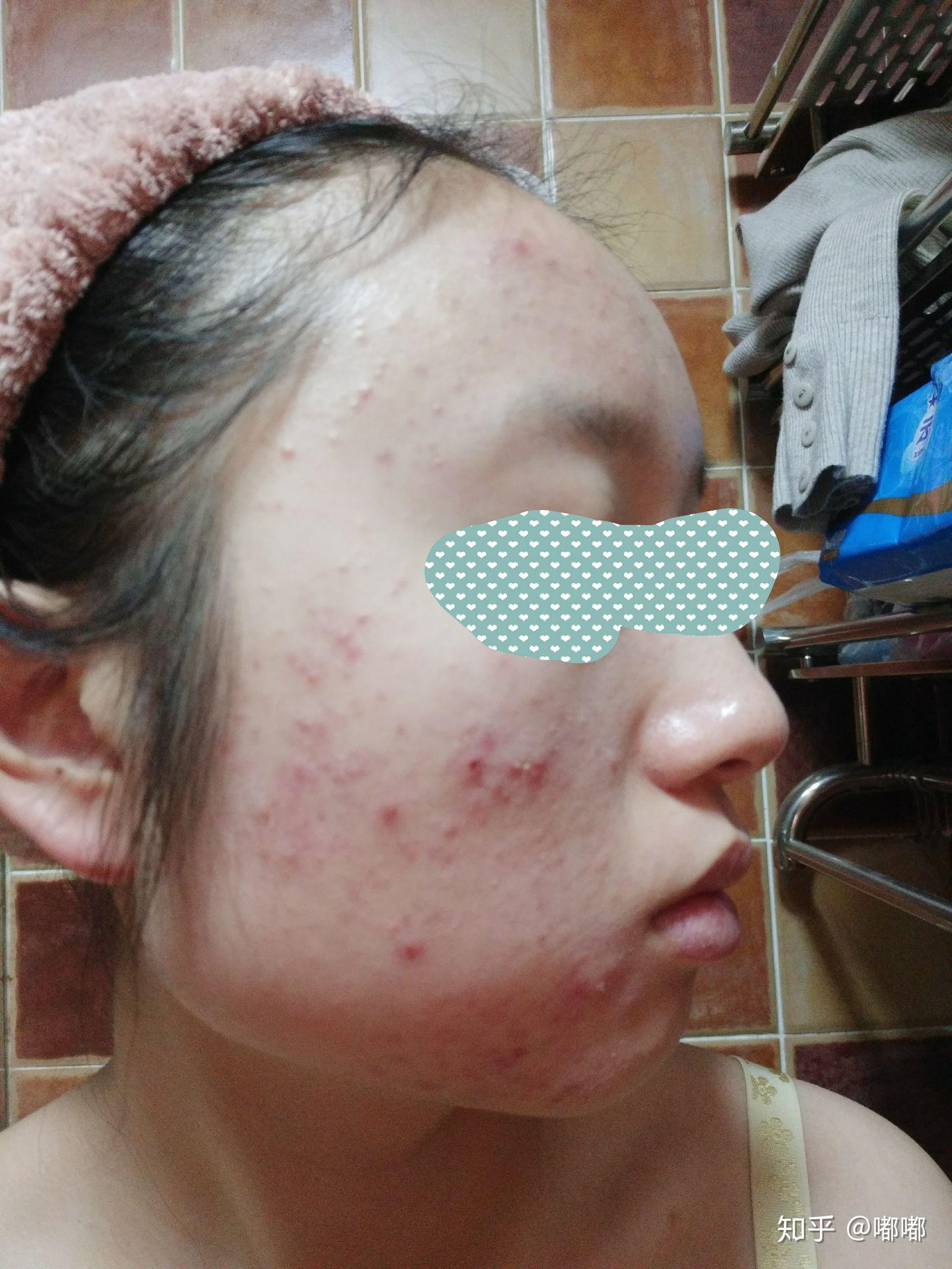 近两天脸上的痘痘变成的脓包破了,挤了有十个露白头的痘痘 - 知乎