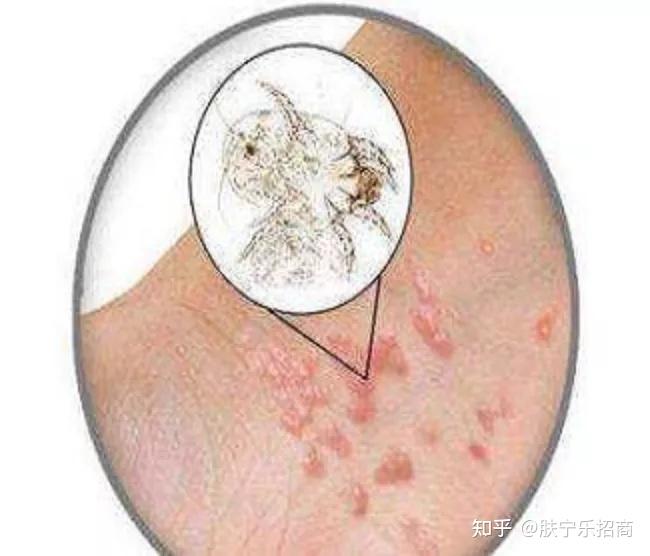 教你走出误区——疥疮小科普 - 知乎