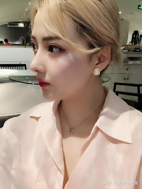 杭州隆鼻术后3个月很自然