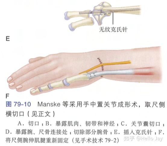先天性手部畸形-形成障碍(发育停止) - 知乎