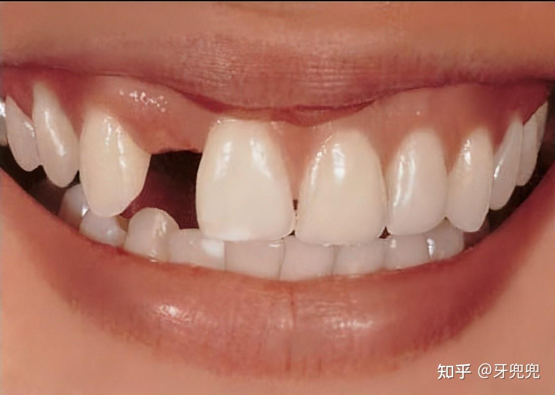 45岁缺牙,应该镶牙还是种牙? - 知乎