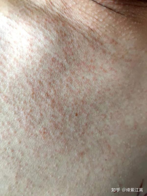 【病毒疹】【发热】【淋巴结肿大】【腹泻】等等,我是怎么把艾滋病急性期症状出全的~ - 知乎