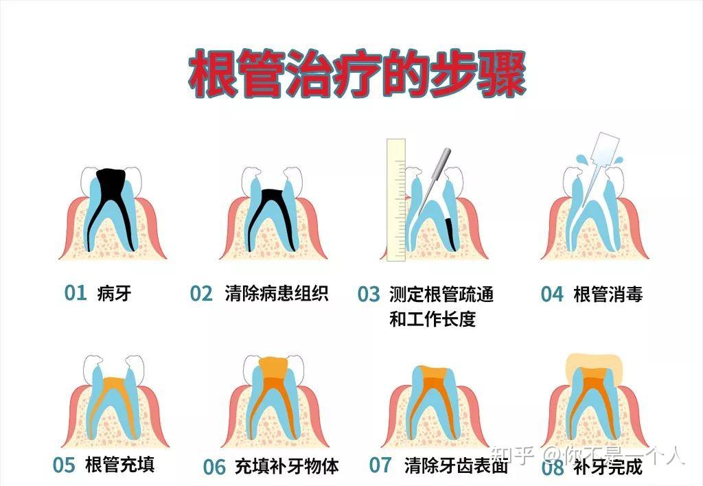 蛀牙补牙过程图解图片