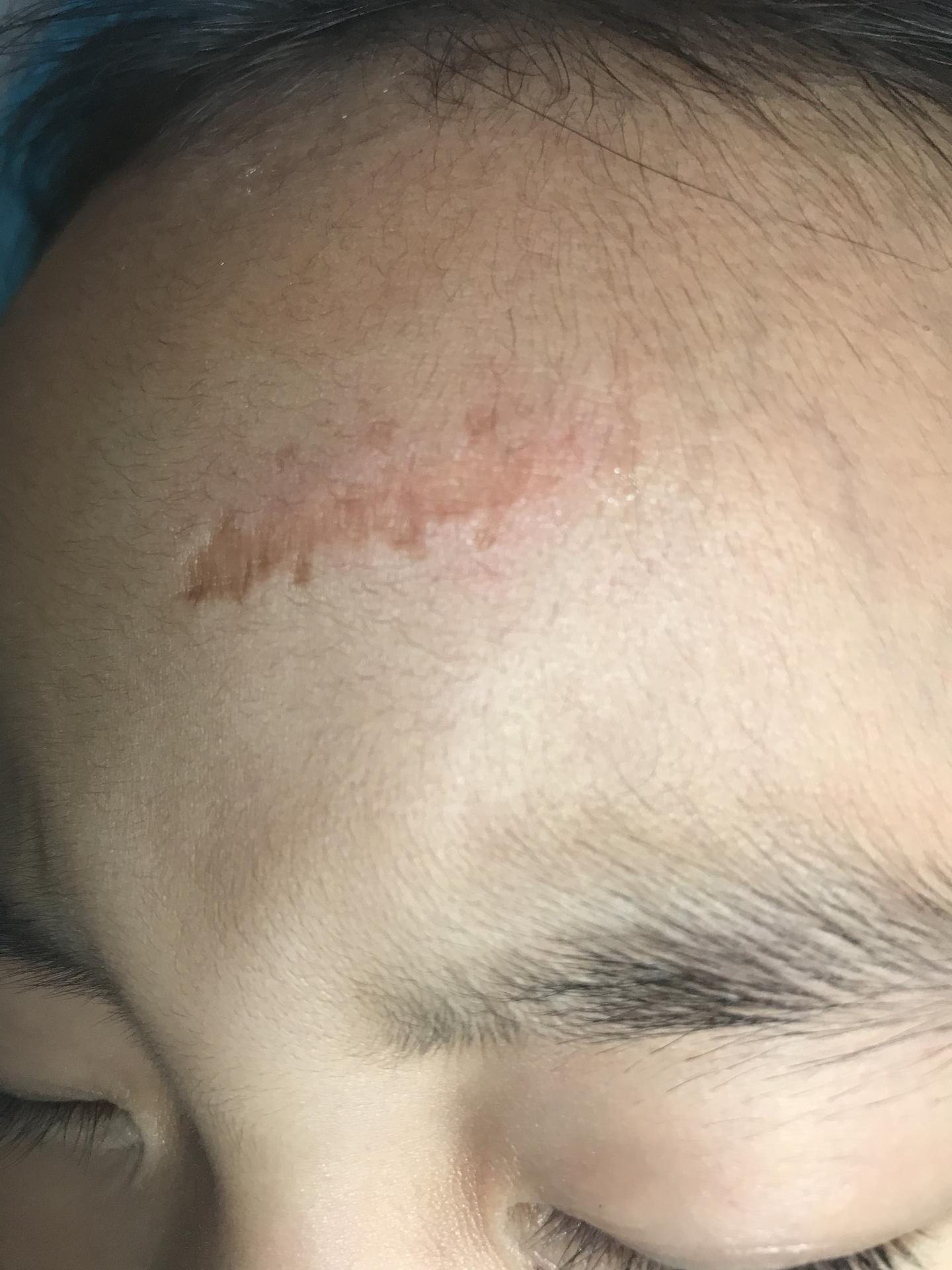 点阵激光修复外伤性疤痕