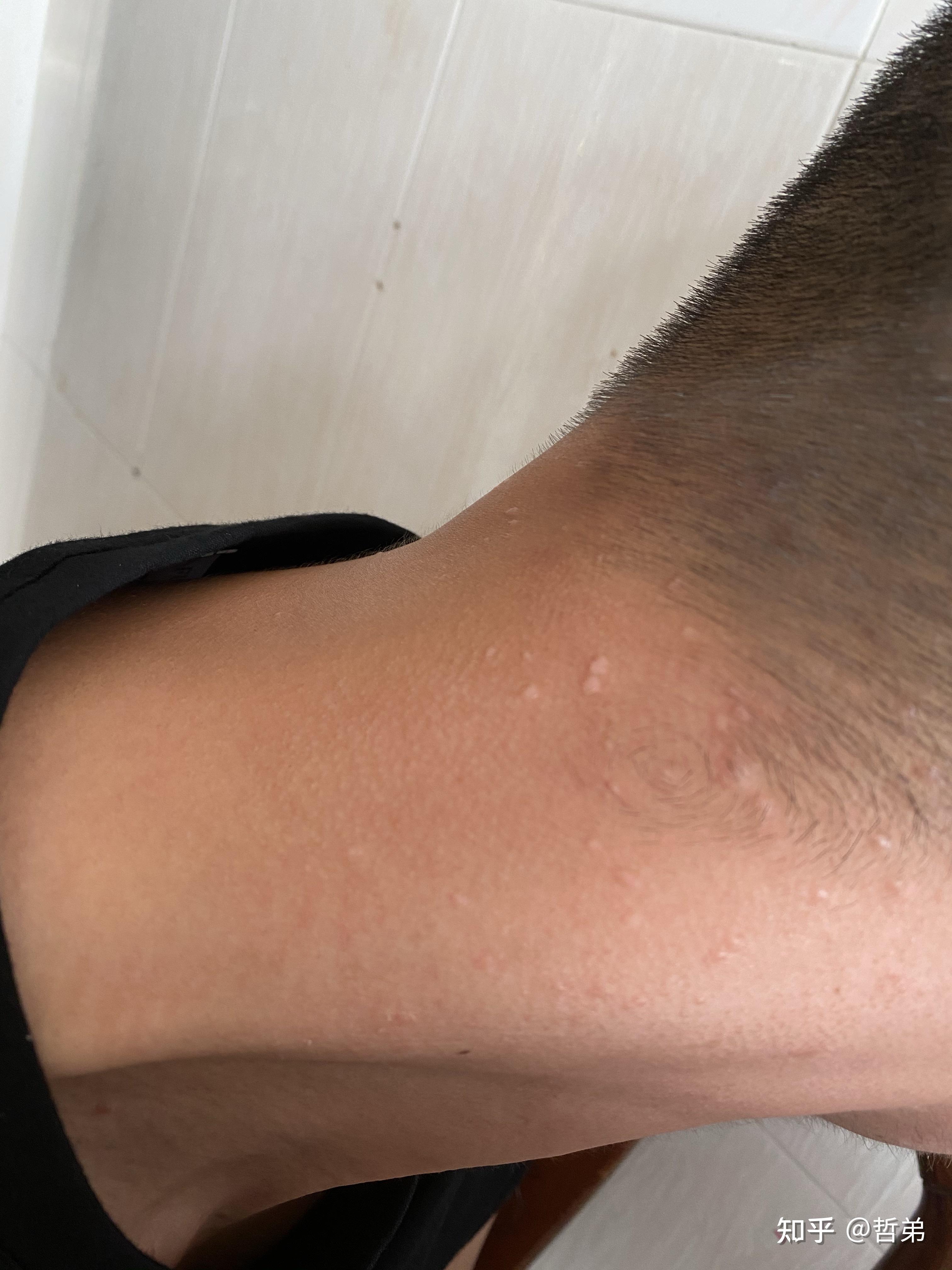 疣性病毒的可怕