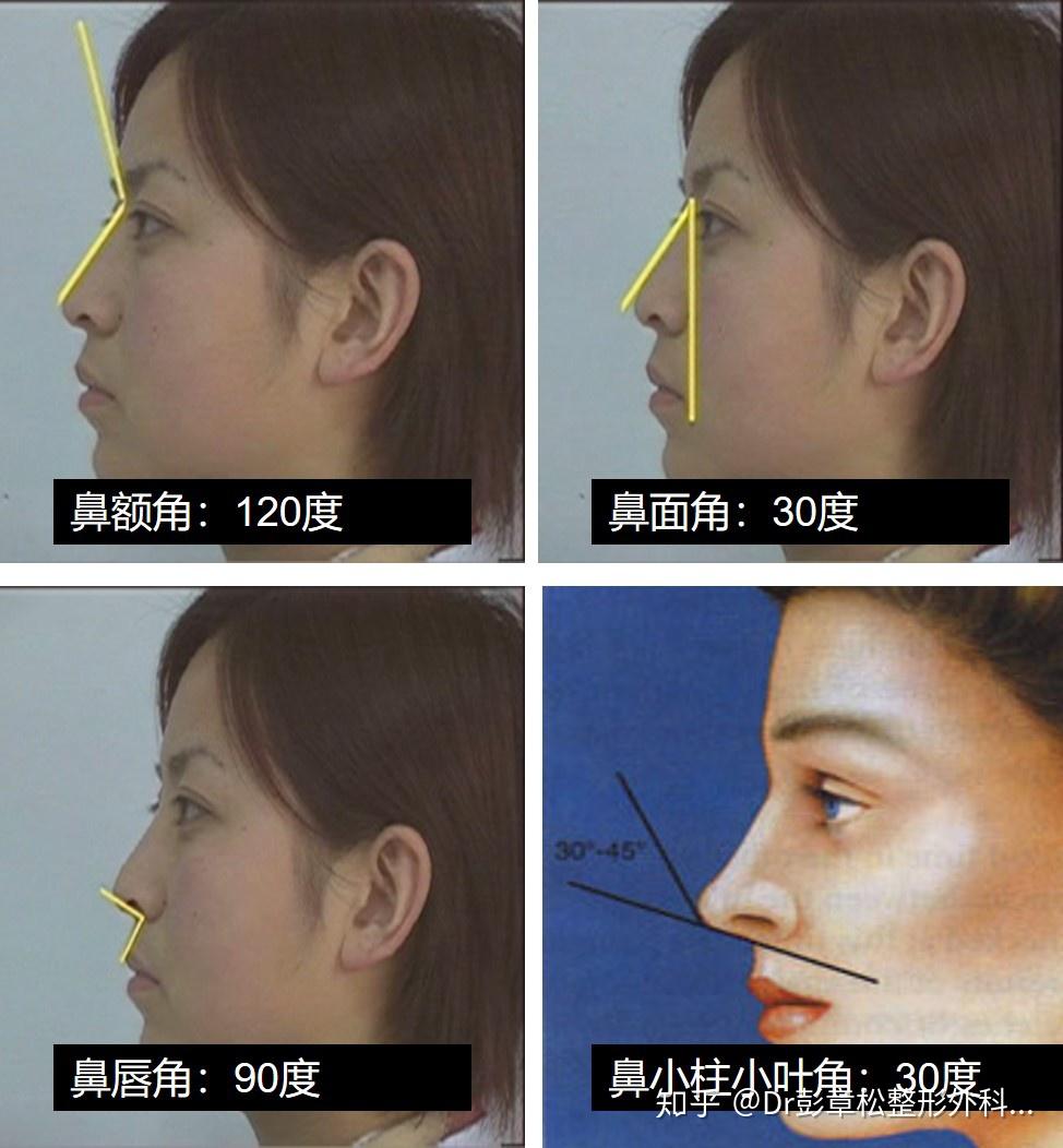 东方人鼻部美学 - 知乎