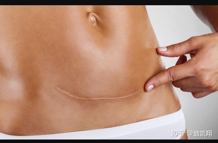 疤痕多久可以手术 v2-a21d343fd63d27517f6fda3cecad83e1_r.jpg
