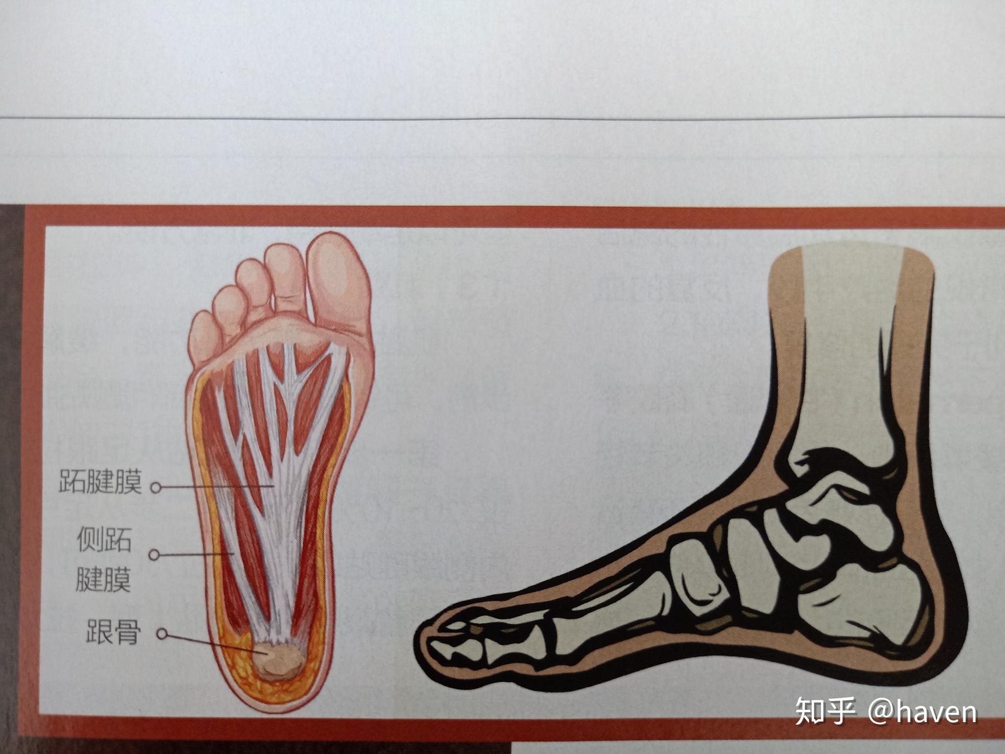 足底筋膜炎是足底肌肉筋膜产生无菌性炎症,引起的足底疼痛