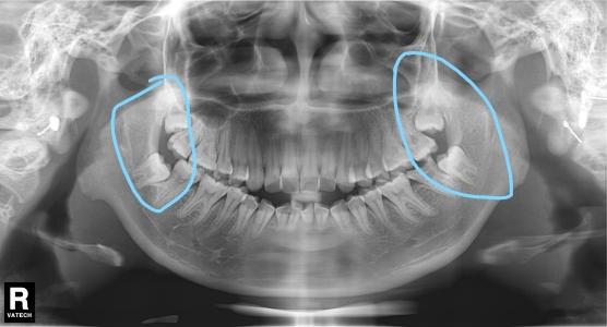 你的智齿应该拔么看完这篇你就更糊涂了