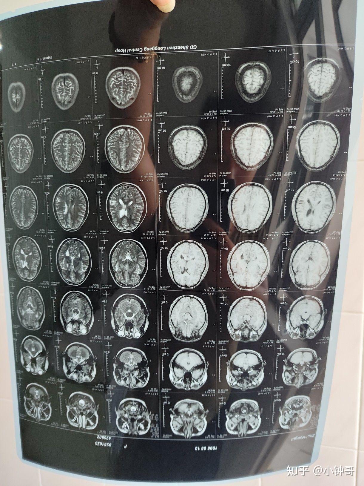 外并进行了核磁共振,cta等检查,医生告知为烟雾病大概两个月前的晚上