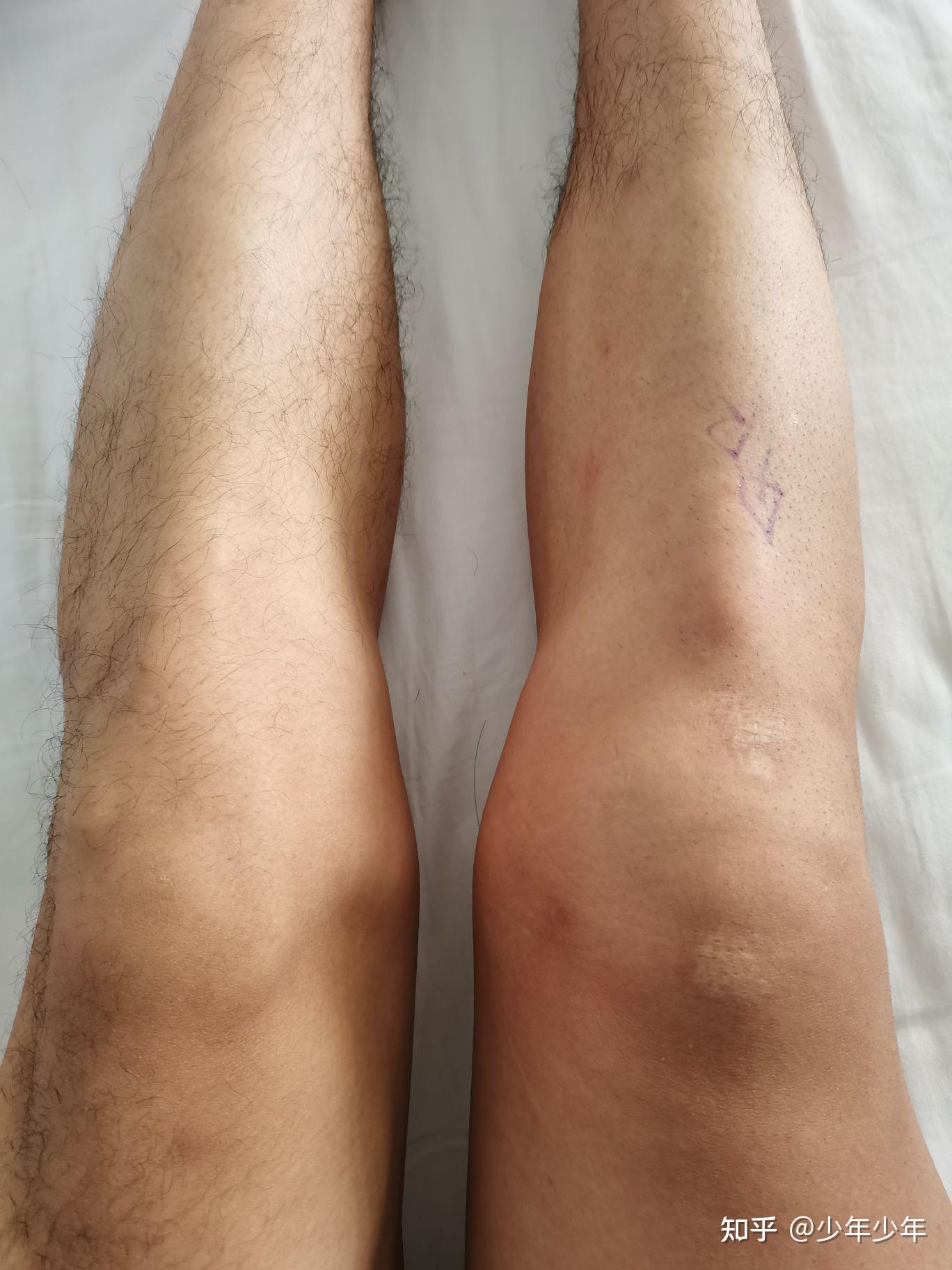 断腿少年—记前叉韧带断裂经历 