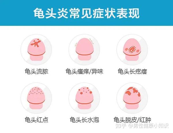 | 春季包皮龟头炎高发期，防治仔细阅读 - 知乎