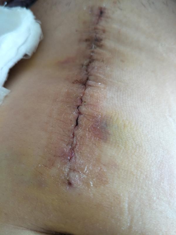 卵巢囊肿手术伤口图片图片