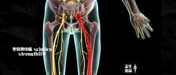 令人神傷的坐骨神經痛
