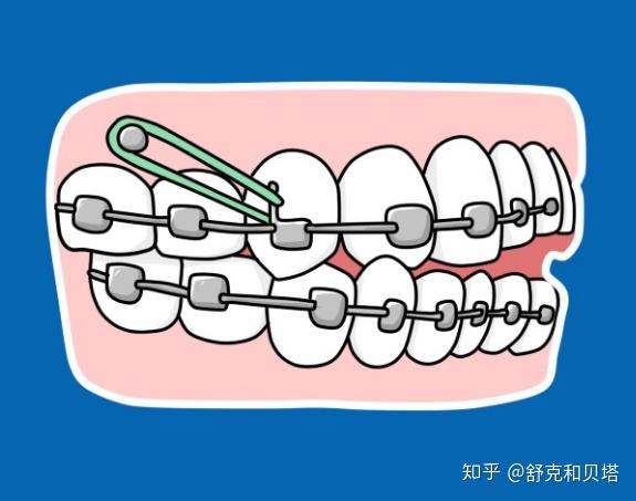 正畸,其实就是通过外力来促使牙齿移动,而橡皮圈就是增加牵引力的辅助