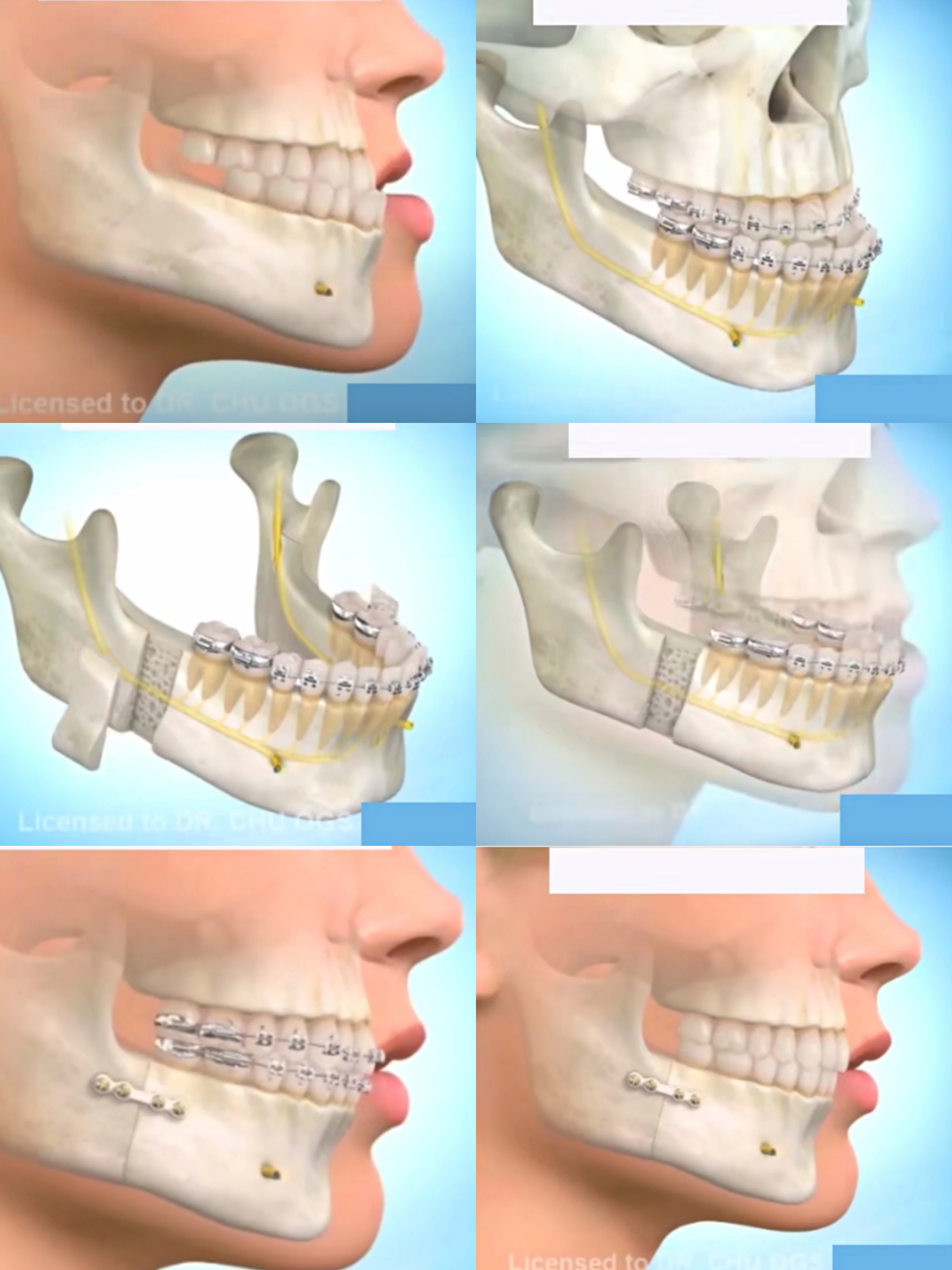 有人做过正颌手术吗效果如何正颌手术费用是多少钱