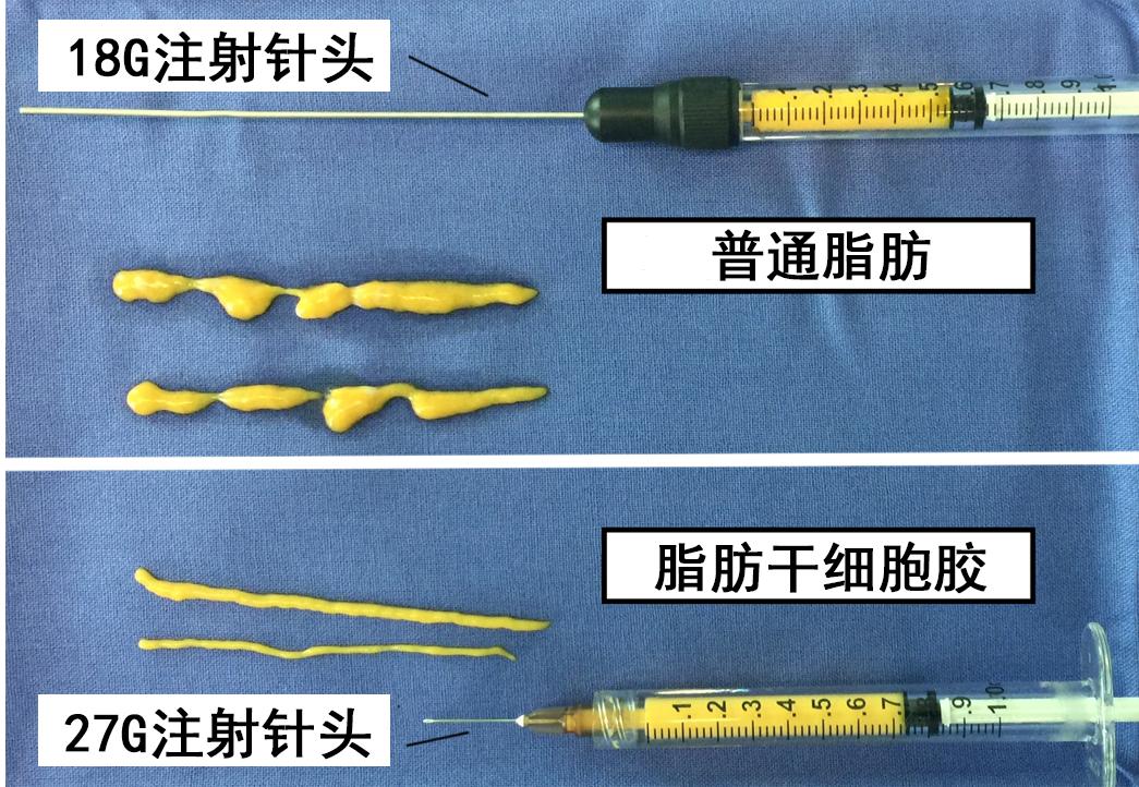 普通脂肪只能通过粗针注射,脂肪干细胞胶可以非常顺利的通过细针注射