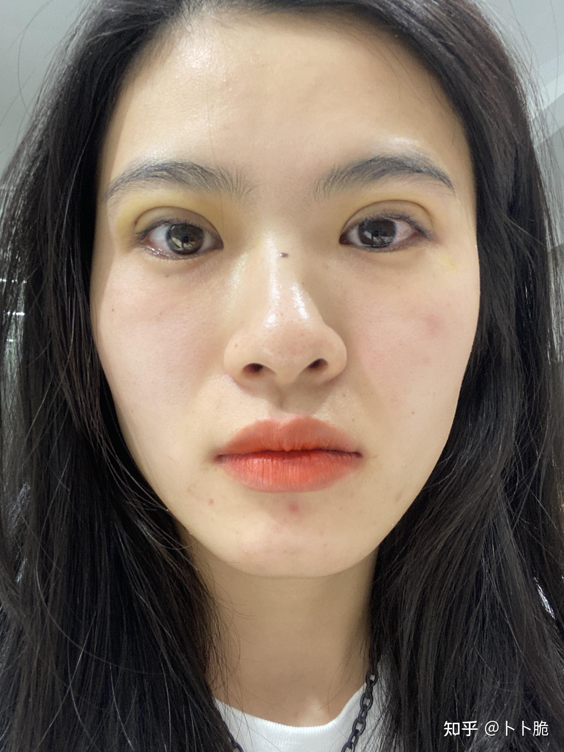 记录埋线双眼皮恢复过程,埋线好像埋宽了,肉条明显 帮我看一下是失败