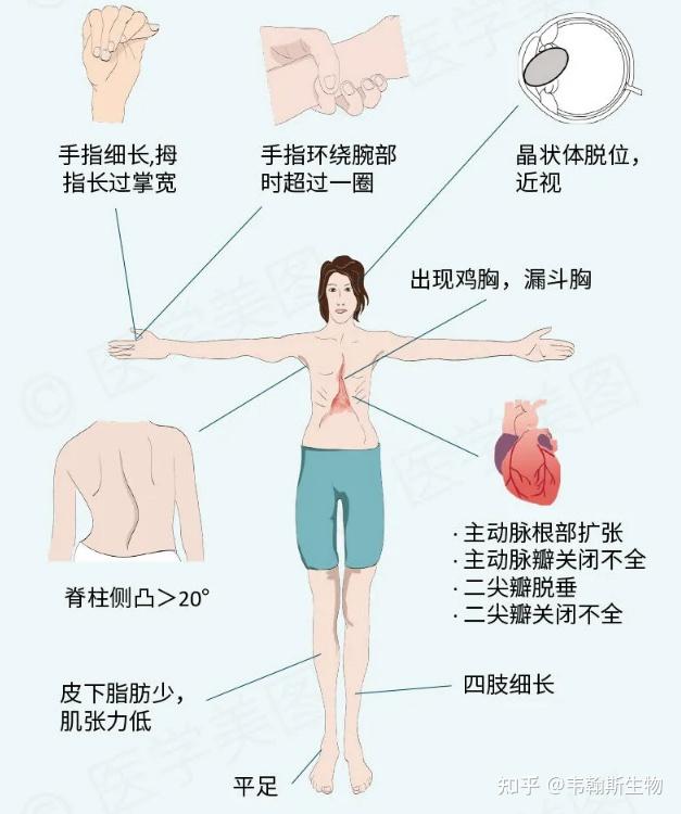 韦翰斯:关于罕见病马凡综合征基因检测,你不知道的事