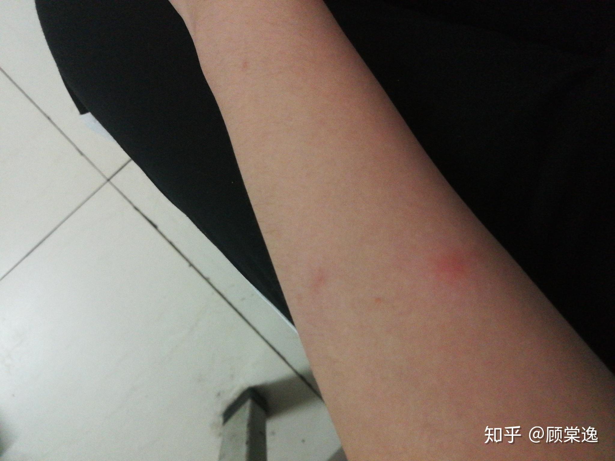 身上总是莫名其妙的起痒包怎么办