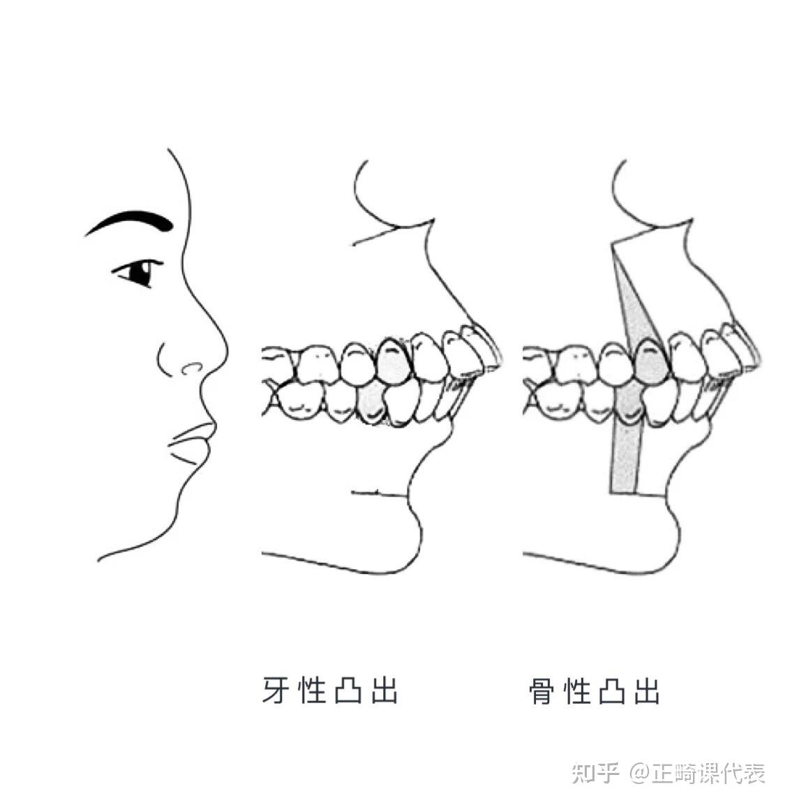 图4-86 上颌牙体倾斜左侧观-口腔颌面及颈部临床解剖学-医学