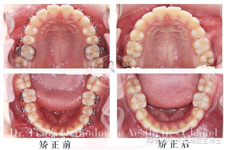 深覆合矫正脸型图片