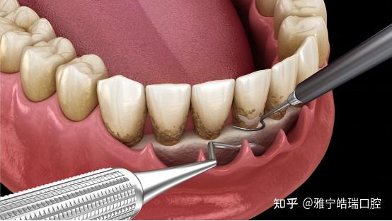 牙周刮治後注意事項:1,認真刷牙,術後當天患者避免大力刷牙,以漱口為