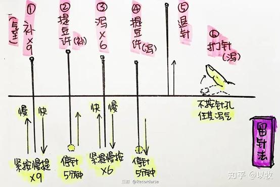 人纪针灸笔记(19)针刺法 - 知乎