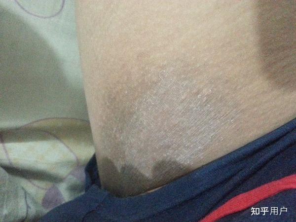 没什么我的大腿内侧总是很痒?